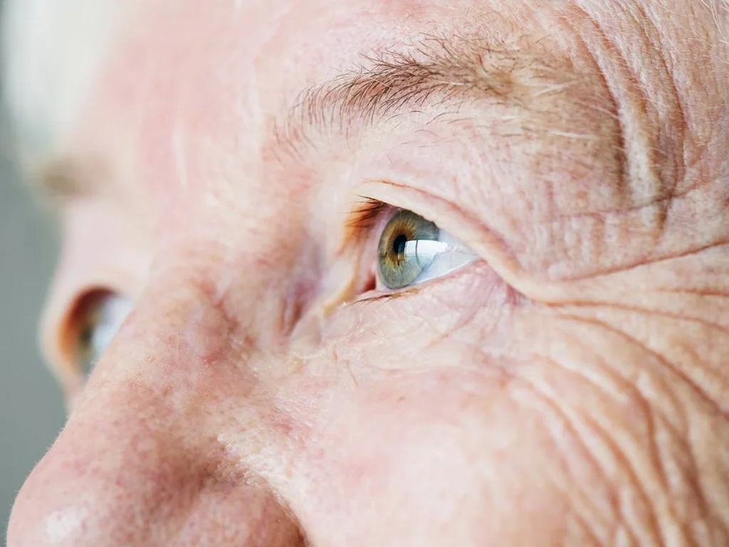 Síntomas de cataratas en adultos mayores