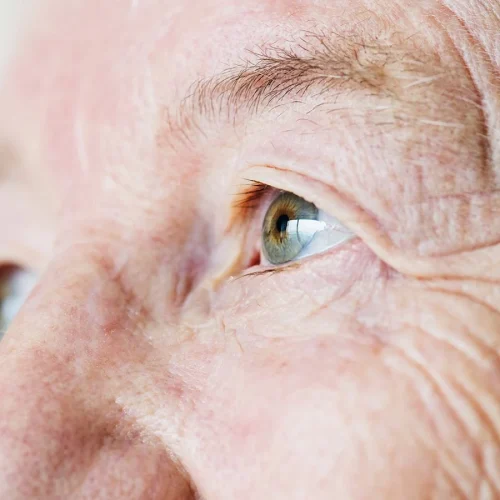 Síntomas de cataratas en adultos mayores